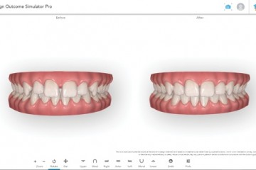 爱齐科技推出全新一代医患交流工具——隐适美效果模拟器专业版，展示模拟矫治后的崭新笑容
